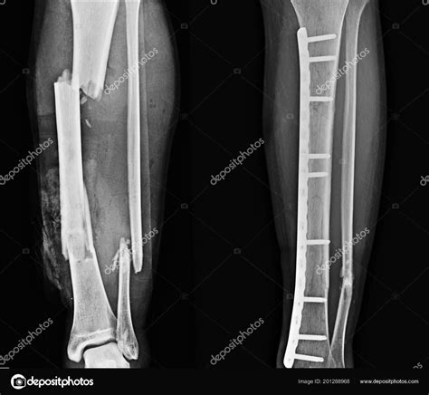 Ray Leg Fracture Fibula Mid Shaft Tibia Oost Orif Plates Stock Photo By
