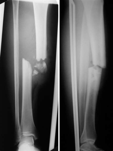 Figure 1proximal Tibiofibular Dislocation Associated With Fracture Of