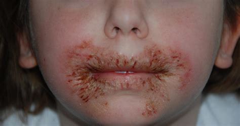 Do not use acne medicines intended for. Baby wipe chemical tied to allergic reactions in some kids ...