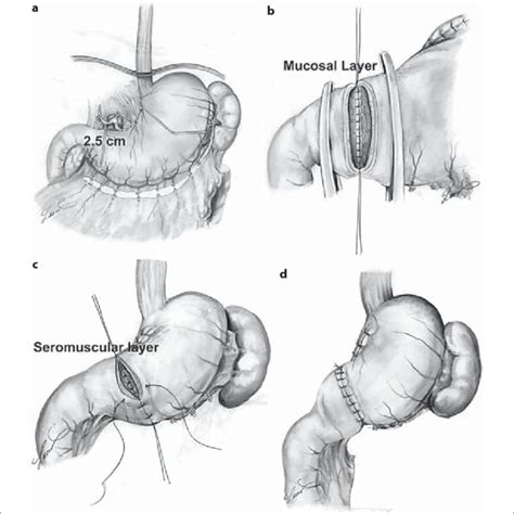 Segment Viii Hepatectomy By Systematic Glissons Pedicle Transection At