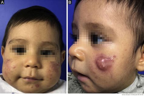 Papulopustular Infantile Acne Treated With Oral Isotretinoin Anais