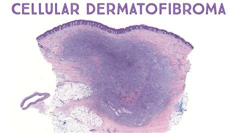 Cellular Dermatofibroma And Hemosiderotic Dermatofibroma Oregon Case 6