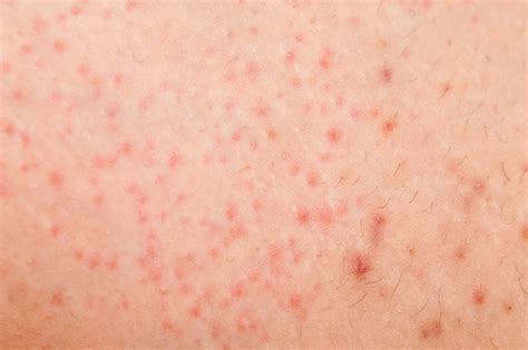 Leukemia Tiny Red Spots On Skin