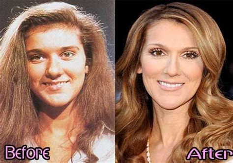 Celine Dion Plastic Surgery Before After Photos Plastic Surgery Celebrities Before And After