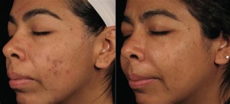 Silkpeel Dermal Infusion For Skin Rejuvenation Dr Chen Tai Ho