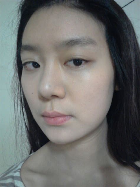 Real Patient Facial Contouring Square Jaw Zygoma Front Chin