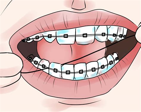 3 Ways To Take Care Of Your Braces Wikihow