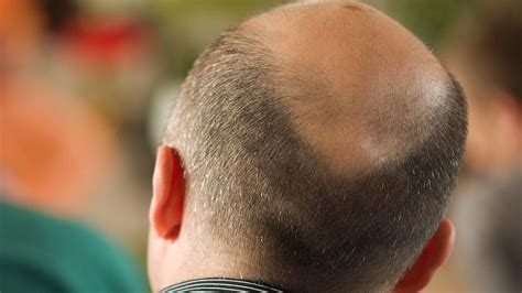 Balding Treatment Why Being Bald Could Become Optional Cairns Post