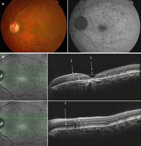 Retinal Dystrophies And Degenerations Springerlink