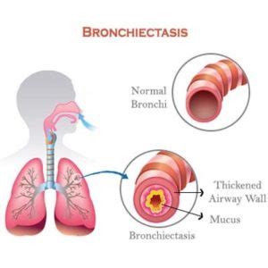Bronchiectasis Treatment Chest Physio Home Physio Group
