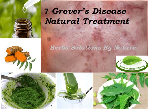 7 Natural Treatments For Grovers Disease