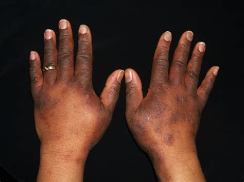 Eczema Atopic Dermatitis Causes Symptoms And Treatment