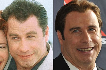 The John Travolta Hair Transplant Story His Hair Clinic