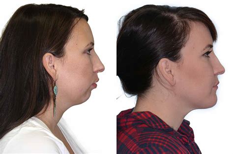 Bite And Nasal Base Correction Corrective Jaw Surgery Dr Antipov