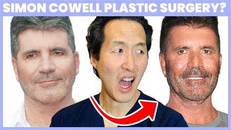 What Happened To Simon Cowells Face Doctor Reacts To Simons Plastic