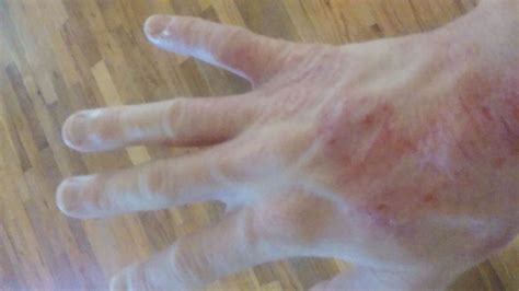 The Itchy And Dry Skin Irritation You Get From Swimming In A Borax