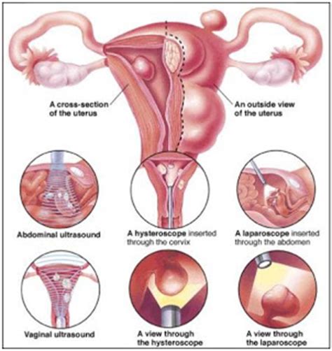 Poke root oil or castor oil have been used for ages to reduce painful breast lumps. Foods That Shrink Fibroids