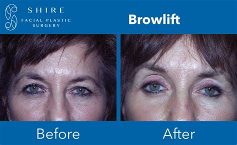 Browlift Before And After Shire Facial Plastic Surgery