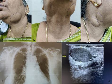 Ac Patient With Multiple Matted Lymph Nodes On Left Side Level Ib