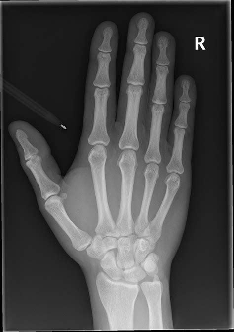 The joint spaces appear normal. Normal hand series | Radiology Case | Radiopaedia.org