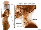 Cervical Discectomy Recovery Images