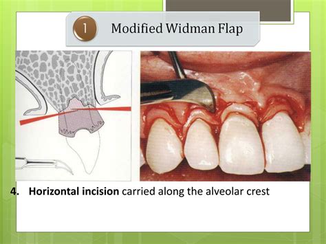 Ppt Periodontal Flap Surgery Powerpoint Presentation Free Download