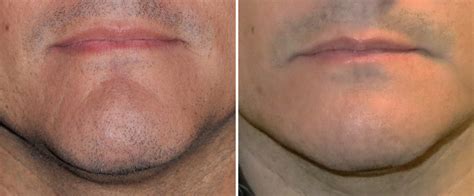 Plastic Surgery Case Study Chin Reduction Surgery By Vertical Bone