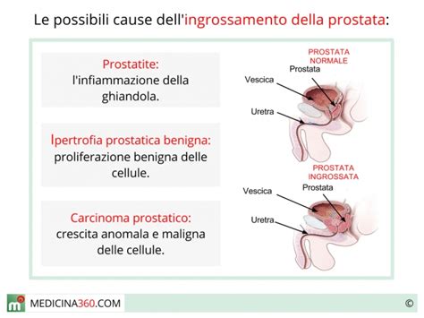 Dacryocystitis Magnetoterápia Prostata Ingrossata Sintomi