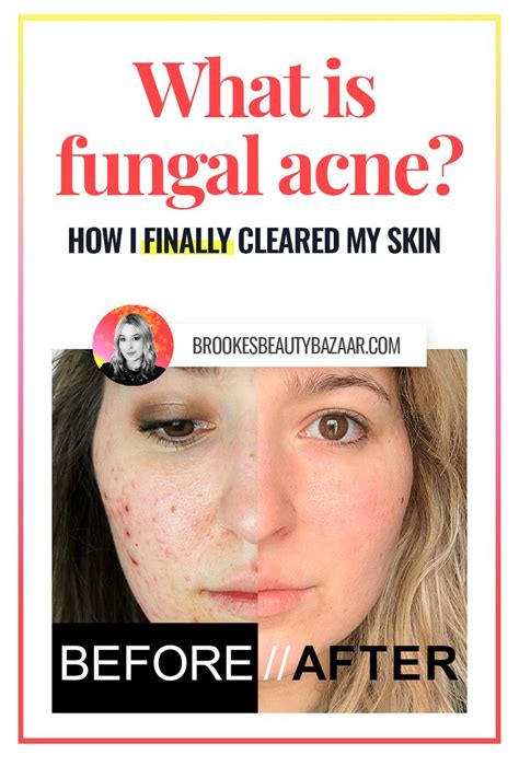 What Is Fungal Acne And Is It Causing The Persistent Bumps On My Forehead Images And Photos Finder