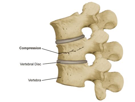 Compression Fracture Shrewsbury Nj And Toms River Nj Center For The