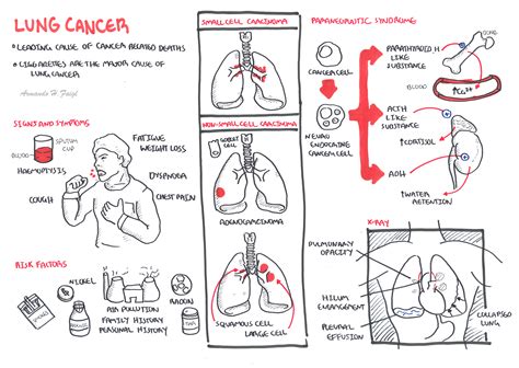 There are various kinds of lung cancers and the exact cause may vary with each type. Lung Cancer | Armando Hasudungan