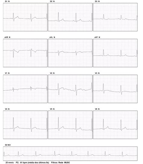 Ecg Con Ritmo Sinusal