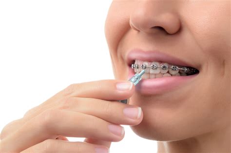 Prevent Tooth Enamel Problems During Braces With Proper Orthodontic