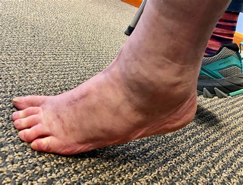 Midfoot Arthritis Patient Stories Paul H Kim Md