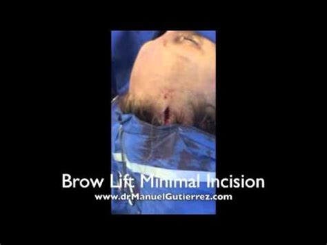 How is a brow lift performed? Brow lift in Tijuana Mexico - Minimal Incision - Dr ...