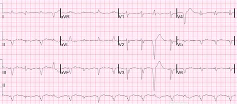 Cardiac arrest see sudden cardiac arrest (sca). Dr. Smith's ECG Blog: Sudden Cardiac Arrest: why does the ...