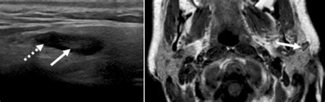 Ultrasound Image On The Left Demonstrates A Normal Intraparotid Lymph