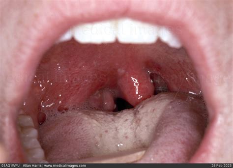 Stock Image Ent Tonsillitis Inflamed And Swollen Tonsils With White