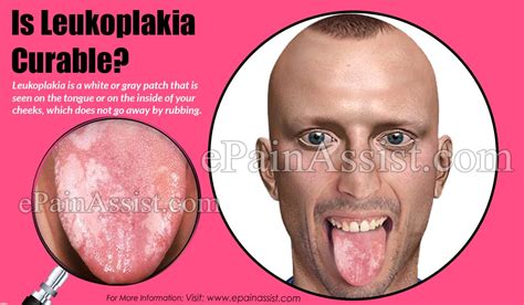 Cheek Leukoplakia Treatment Leukoplakia Causes Pictures Symptoms