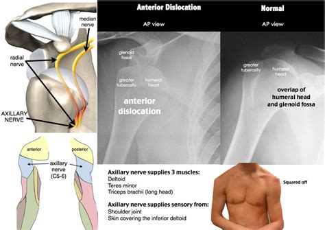 Dislocation With Images Axillary Nerve Median Nerve Medical Mnemonics