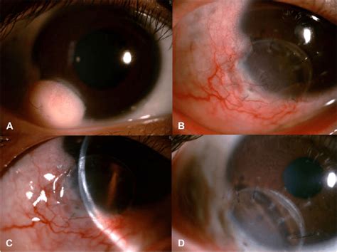A A 18 Year Old Boy With A Limbal Dermoid At The Inferotemporal Region