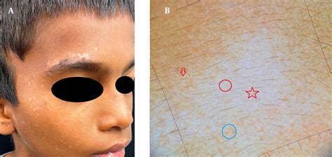 A Clinical Image Of Vitiligo Showing Depigmented Patch On The Face B
