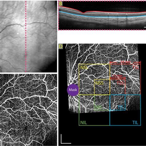 Representative Swept Source Optical Coherence Tomography Angiography