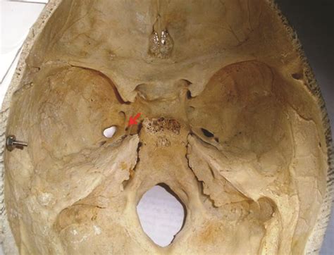 Middle Cranial Fossa Showing Oval Shaped Foramen Vesalius On Left Side
