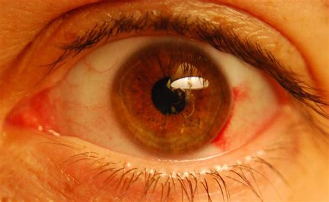 Subconjunctival Hemorrhage Broken Blood Vessels In The Eye Healdove