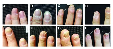 The Clinical Manifestations Of Nail Involvement Of Psoriasis A