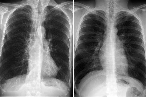 Emphysema Chest X Ray