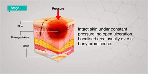 Skin Pressure Ulcer Stages