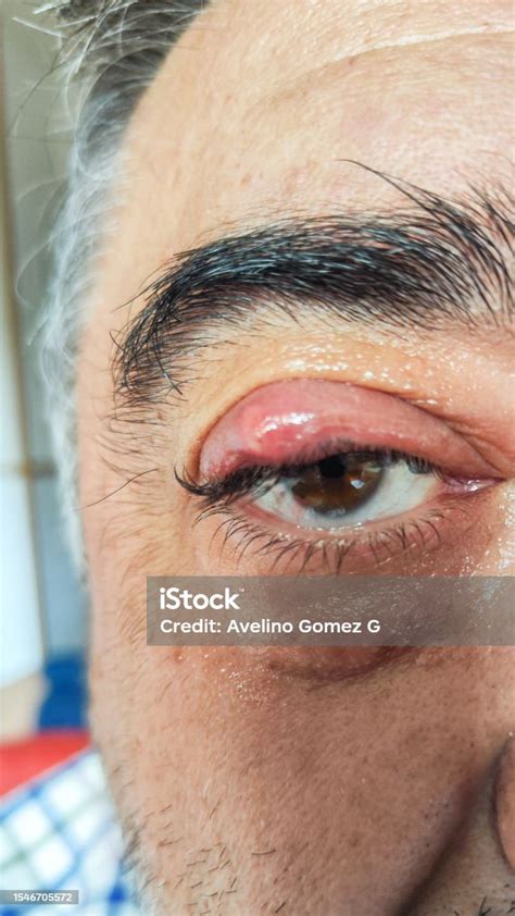 Man With Stye Infection Upper Eyelid Upper Eyelid Concept Sanitation