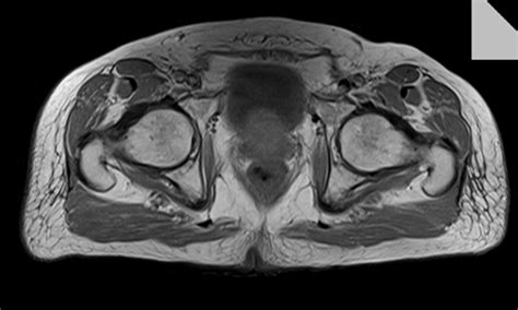 The thigh muscles are divided into three compartments: thigh mri t1 axial image